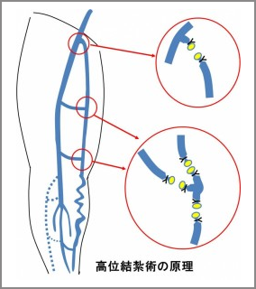 高位結紮術