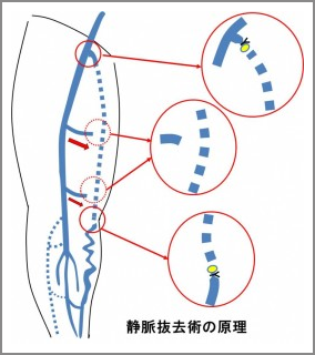 ストリッピング(静脈抜去術)